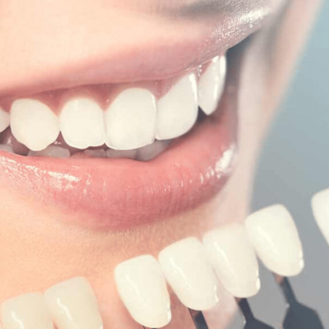 Lentes de Resina Maringá (1)